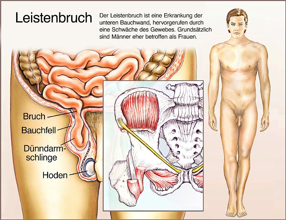 Die Grafik zeigt, an welcher Stelle der Leistenbruch genau entsteht.