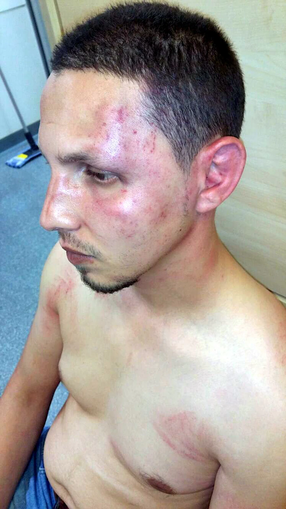 Mustafa (28) aus Syrien zeigt seine Verletzungen.