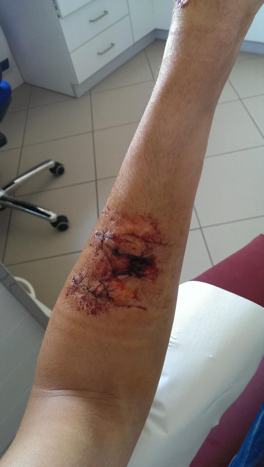 Die Wunde am Arm von Felix Donath. Mit dem Arm war der Sportler am Außenspiegel des Autos hängen geblieben.