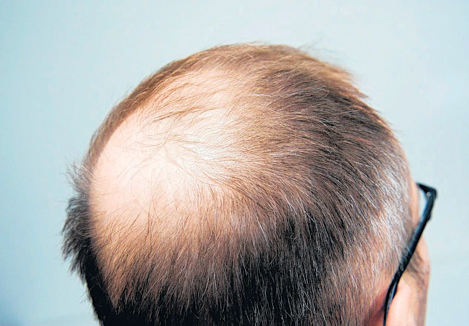 Herzinfarkt-Gefahr kann durch eine Haaranalyse nachgewiesen werden.