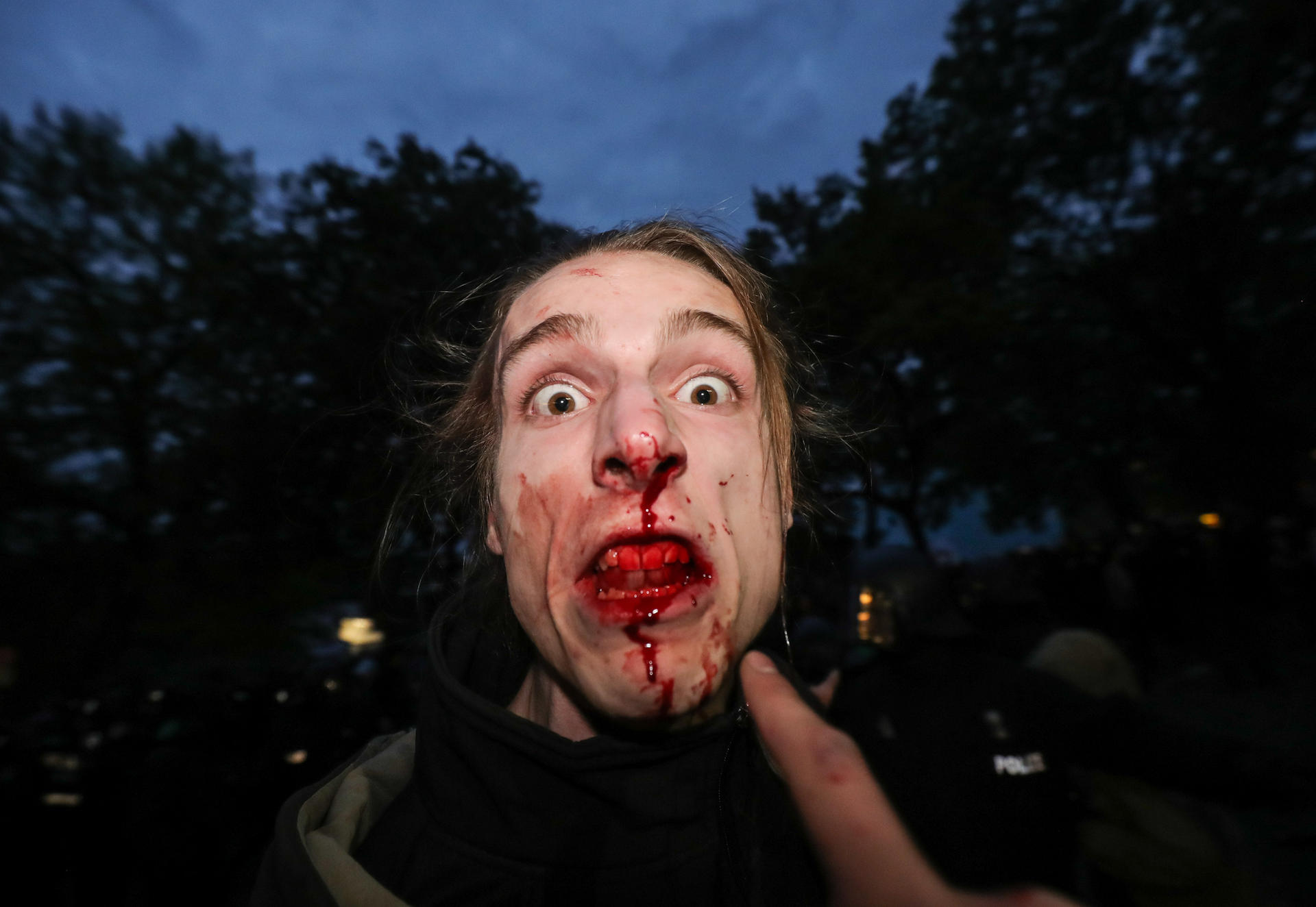 Ein linker Demonstrant blutet heftig im Gesicht.