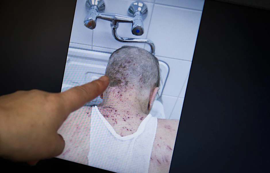 Ein Patient, der von Krätze befallen ist. 