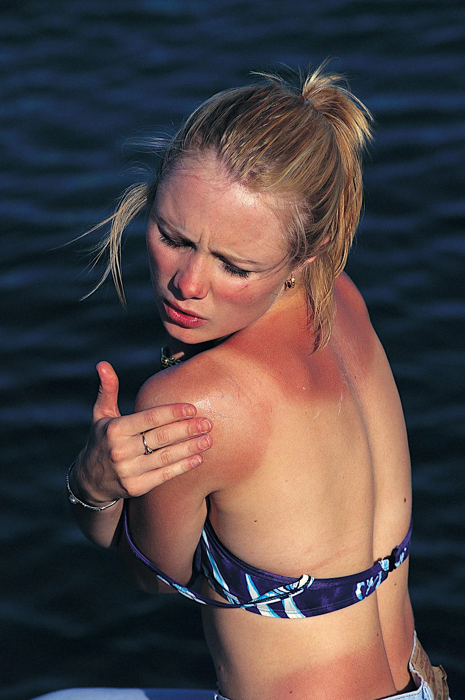 Das Top, vor dem Bikini getragen, hat nicht genug geschützt: Diese Frau hat sich einen üblen Sonnenbrand zugezogen.