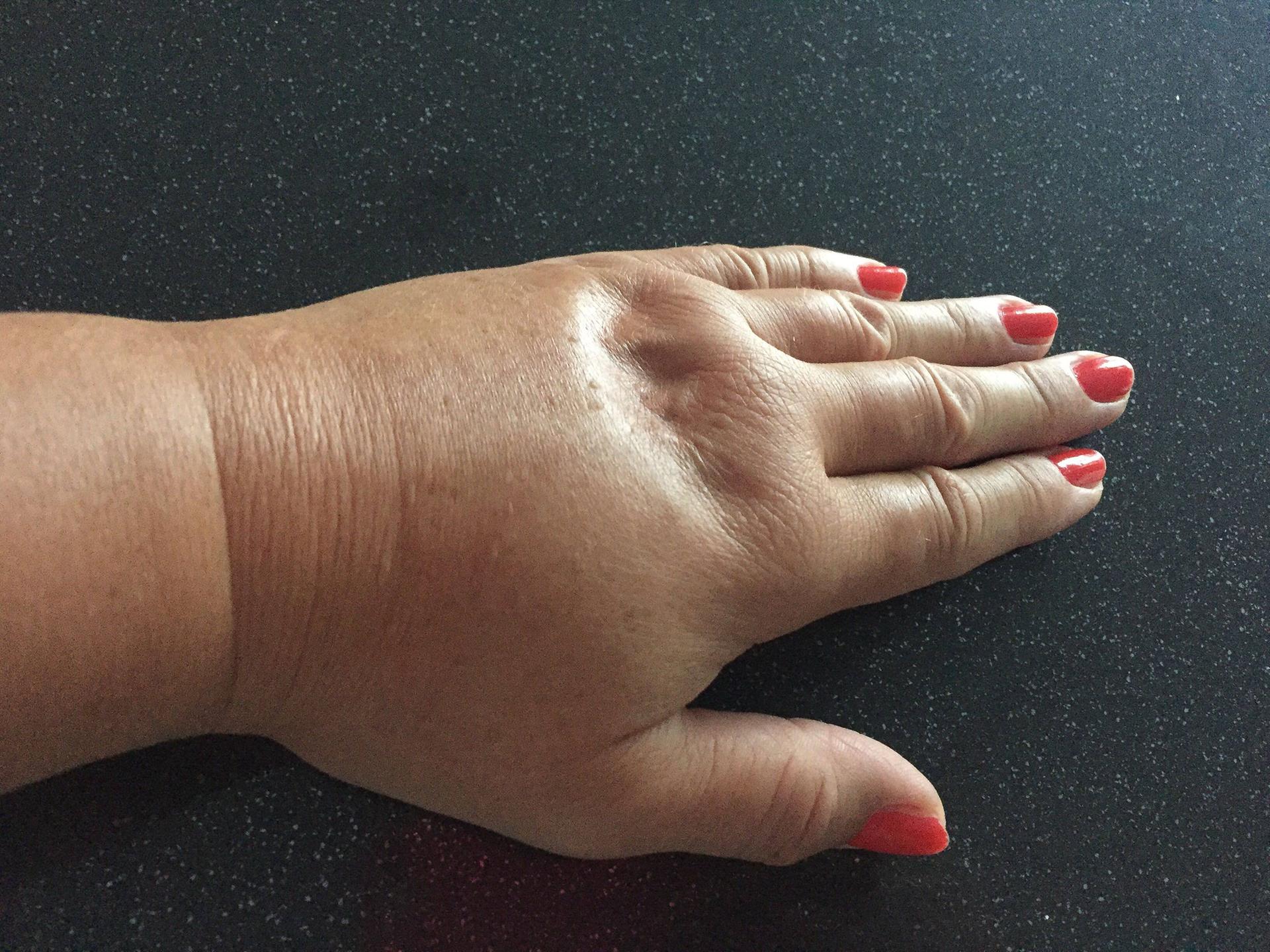 Image - Tödliche Gefahr bei Wespenstichen: Berliner Apotheken ohne Notfall-Spritzen für Allergiker