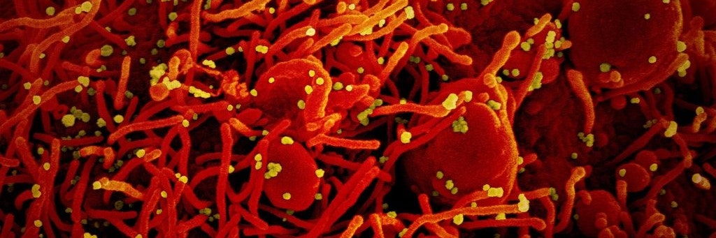 Foto dpa/picture alliance/Niaid/Europa Press Eine Zelle (rot) ist mit dem Coronavirus (gelb) infiziert.