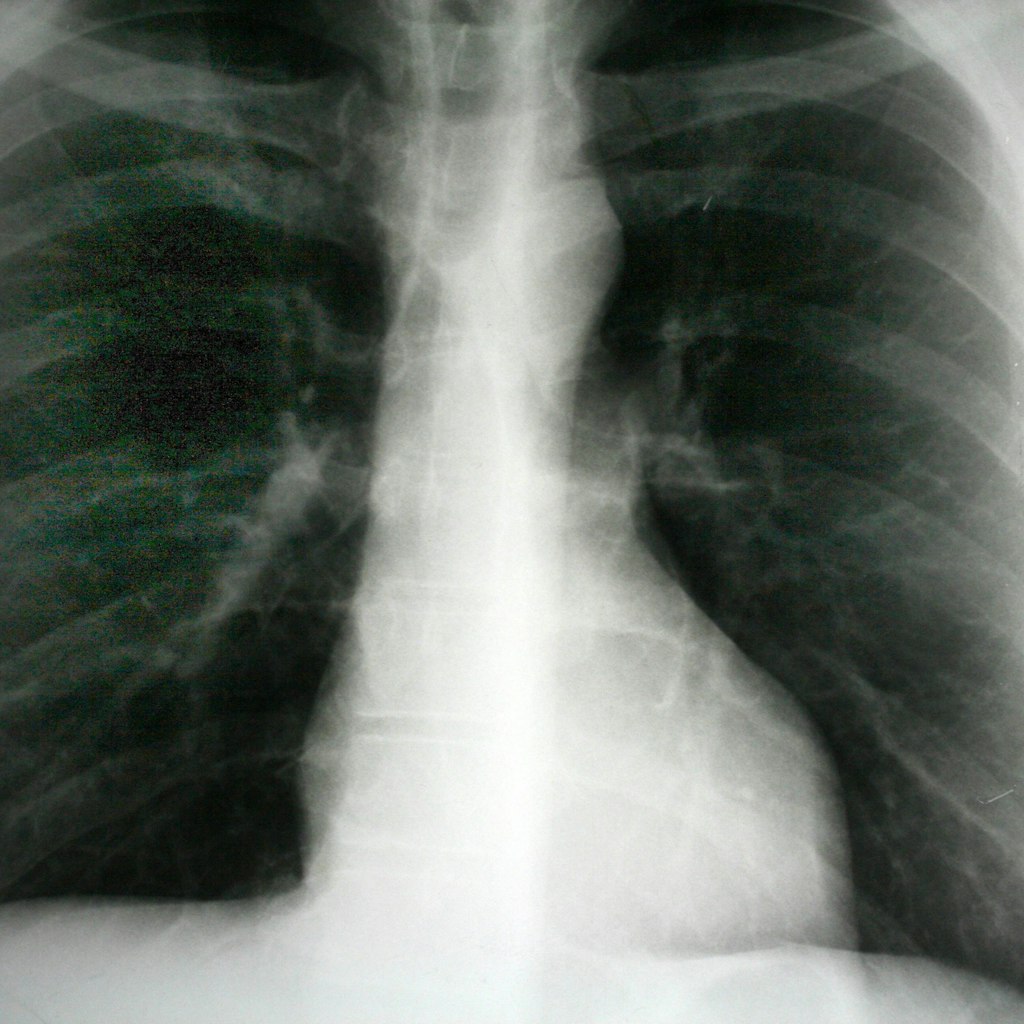 Eine Röntgenaufnahme des Brustkorbs (Thorax).