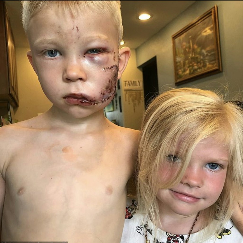 Bridger Walker mit verletztem Gesicht und seiner kleinen Schwester.