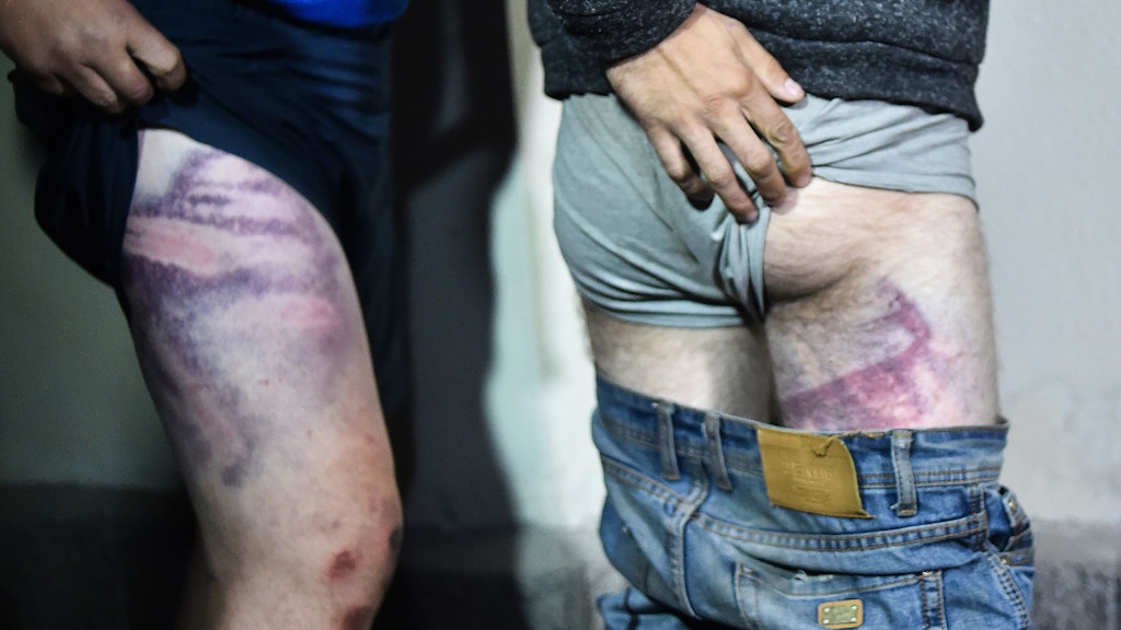 Männer zeigen die Folgen der Polizei-Prügel: Ihre Beine sind mit Blutergüssen übersät.