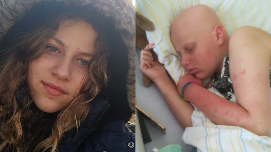 Dramatisches Vorher-nachher-Bild: Feli vor der Diagnose (links) und während der Chemotherapie.