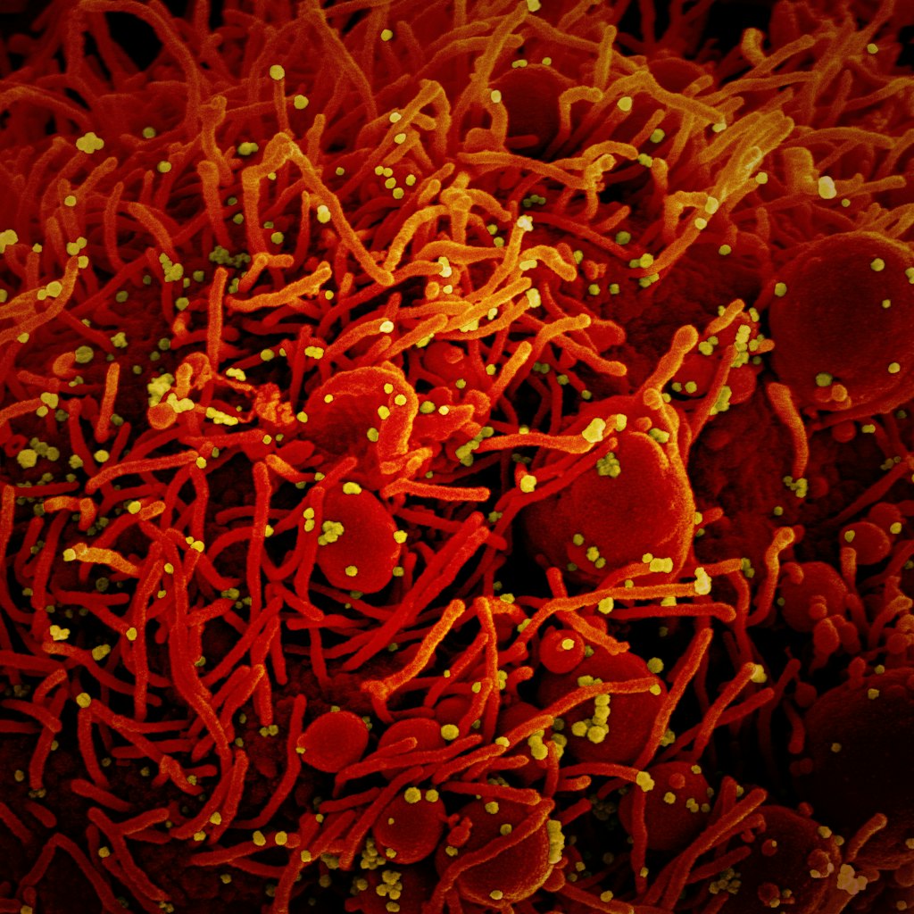 Eine Zelle (rot) ist mit dem Coronavirus (Sars-CoV-2, gelb) infiziert. Die Probe wurde von einem Patienten in den USA isoliert.