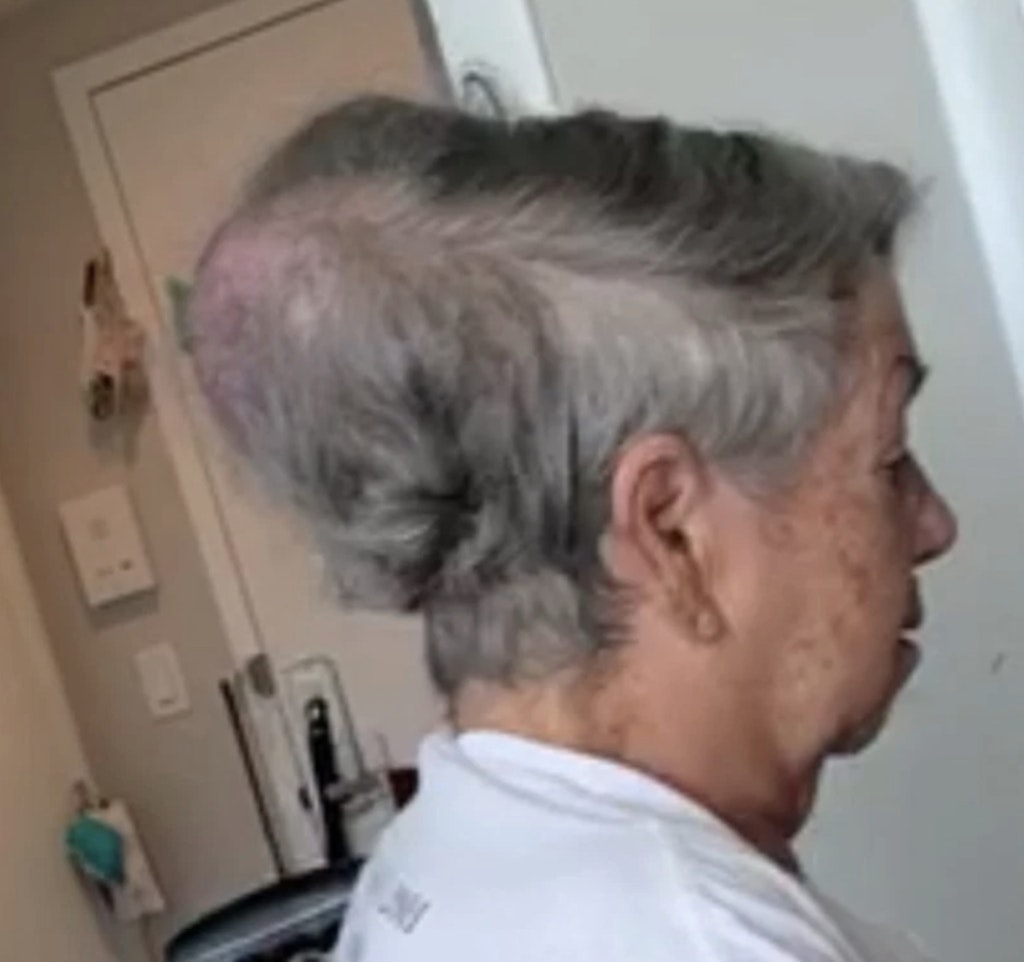 Der Tumor wuchs bis auf die Größe einer Melone.