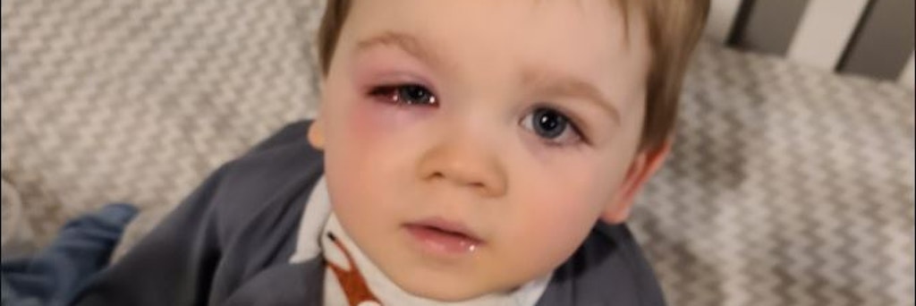Schimmel griff die Augen des Jungen an. 