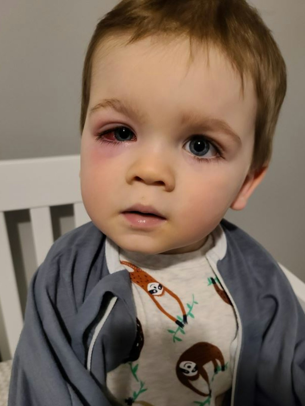 Der kleine Baylor litt unter geschwollenen Augen. 