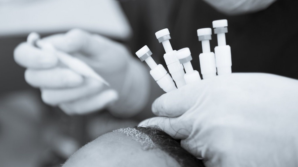 Haartransplantation mit der DHI Methode / 