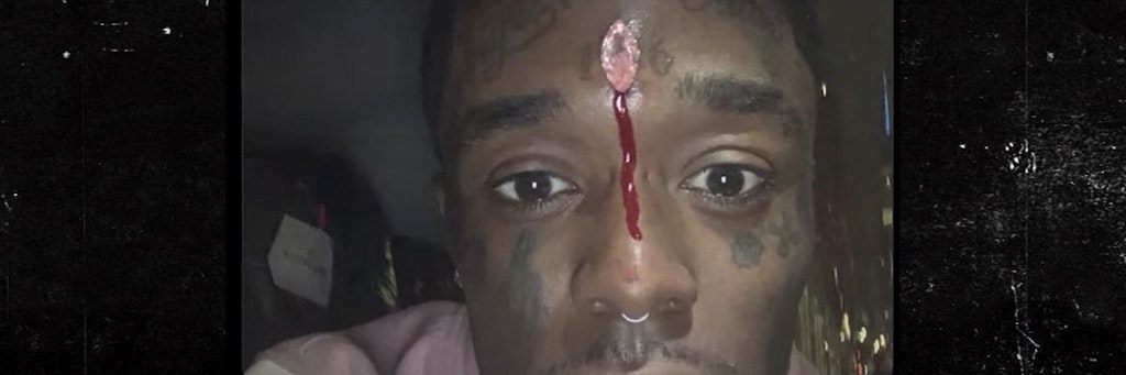 Rapper Lil Uzi Vert ließ sich einen 24-Millionen-Dollar-Diamanten in die Stirn implantieren. Doch das Teil macht nur Ärger.