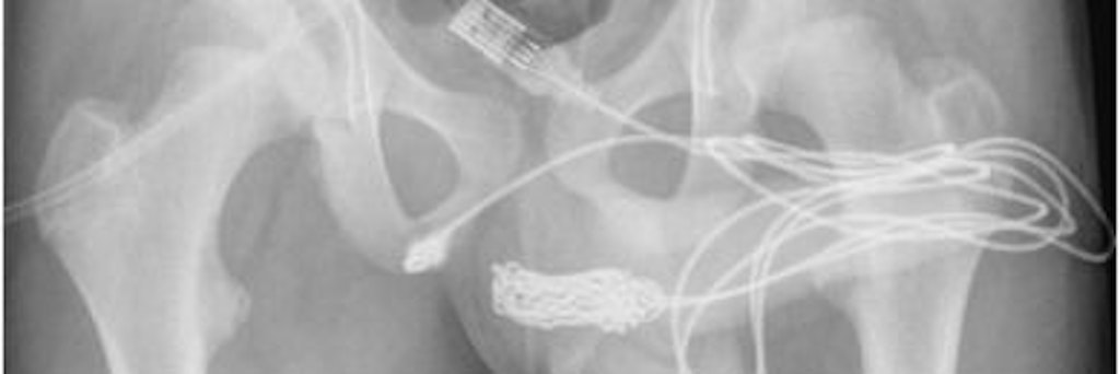 Ein Teenager musste operiert werden, nachdem er ein USB-Kabel in seinen Penis eingeführt hatte. Ein Beckenröntgenbild zeigt den Knoten des mittleren Teils des elektrischen Kabels in der Penisharnröhre.
