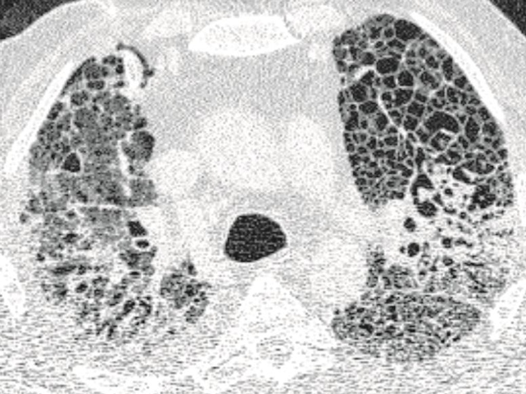 Die verwüstete Lunge eines schwer an Covid-19 erkrankten Patienten, wie sie sich bei einer Computer-Tomografie (CT) darstellt: Helle Bereiche zeigen Verdichtungen und Vernarbungen des Lungengewebes. 