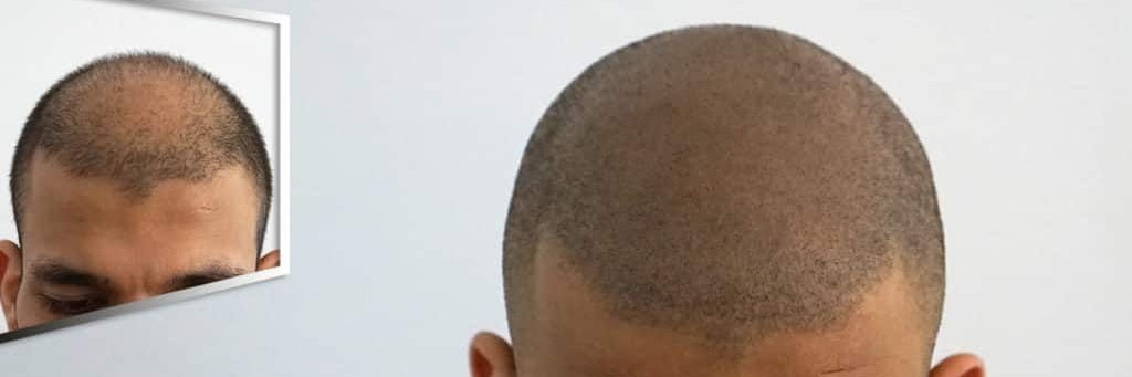Natürlich aussehende Ergebnisse erreichen bei OpticHair