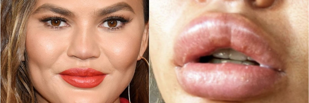 So sieht Model Chrissy Teigen normalerweise aus (li.). Doch derzeit sind ihre Lippen grotesk angeschwollen (re.).