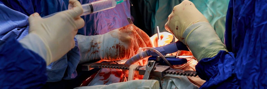 Ärzte operieren einen Patienten am Herzen (Symbolbild).