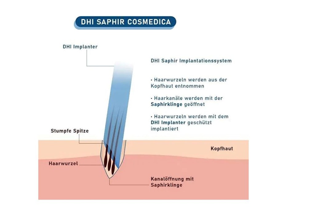 Dr. Acar wendet in seiner Klinik nur die FUE und DHI Technik an.