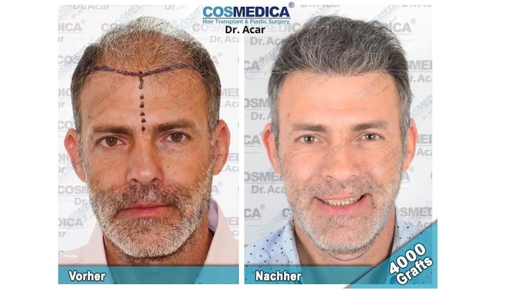 Erstaunliche Ergebnisse einer Haartransplantation bei Dr. Acar in Istanbul