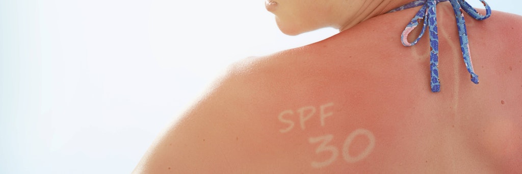 Was für ein Unterschied: Ohne Sonnencreme sieht die Haut nach dem Sonnenbad aus, wie rund um den Schriftzug, der mit schützender Creme auf die Schulter geschrieben wurde.