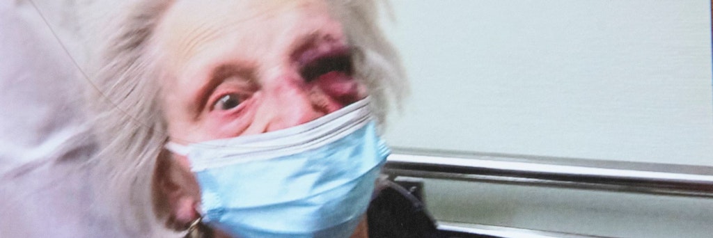 Mit schweren Gesichtsverletzungen kam Anita W. (90) ins Krankenhaus, nachdem sie überfallen wurde.<br>