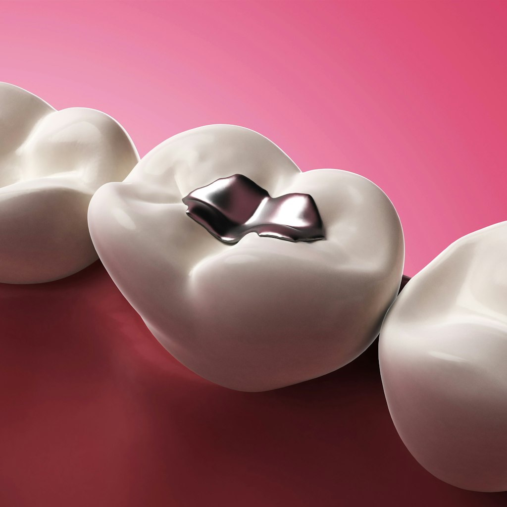 Amalgam ist ein schweres Wort.