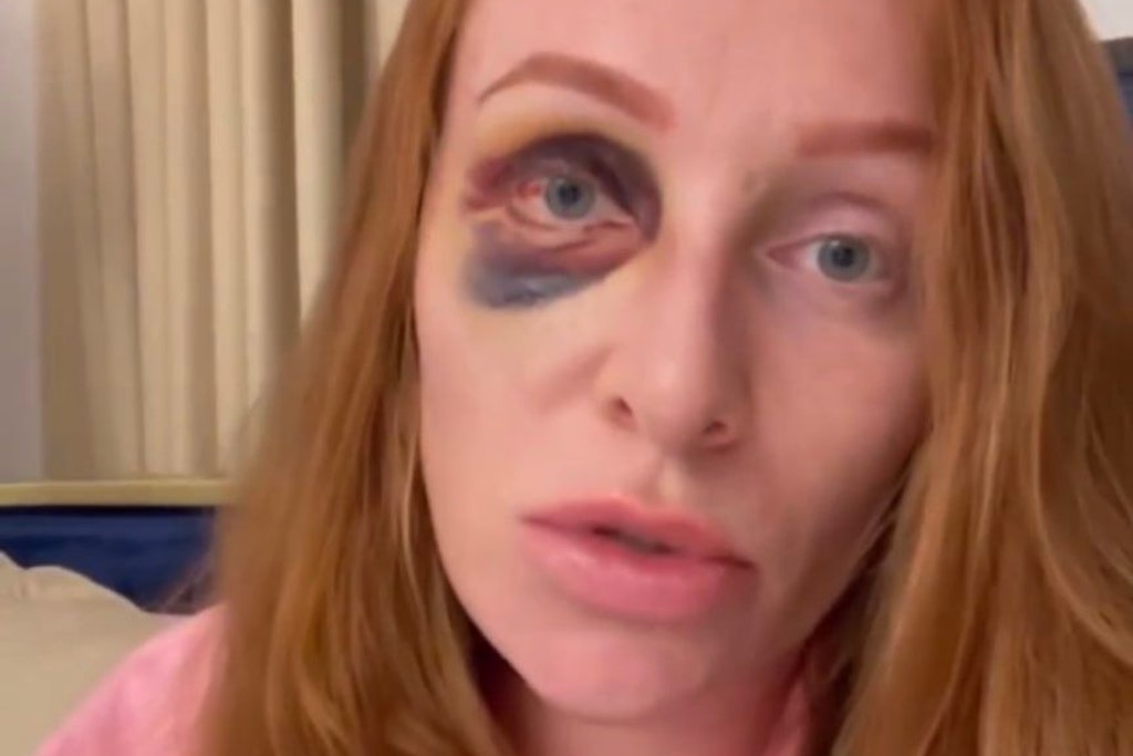 Vor fünf Tagen soll ihr Ex Kubilay Özdemir Georgina Fleur ins Gesicht geschlagen haben.