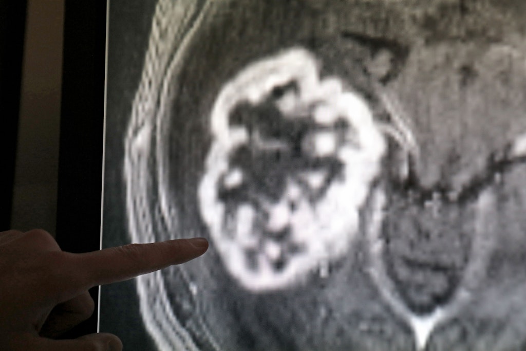 Ein Tumor wird hier mithilfe der Magnetresonanztomografie festgestellt.