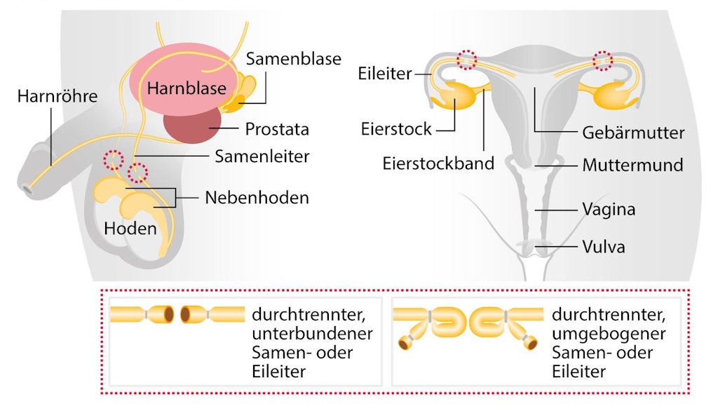 Sterilisation bei Männern und Frauen und Männern