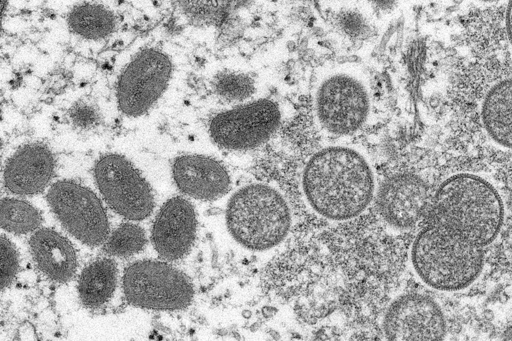 Diese elektronenmikroskopische Aufnahme aus dem Jahr 2003, die von den Centers for Disease Control and Prevention zur Verfügung gestellt wurde, zeigt reife, ovale Affenpockenviren.
