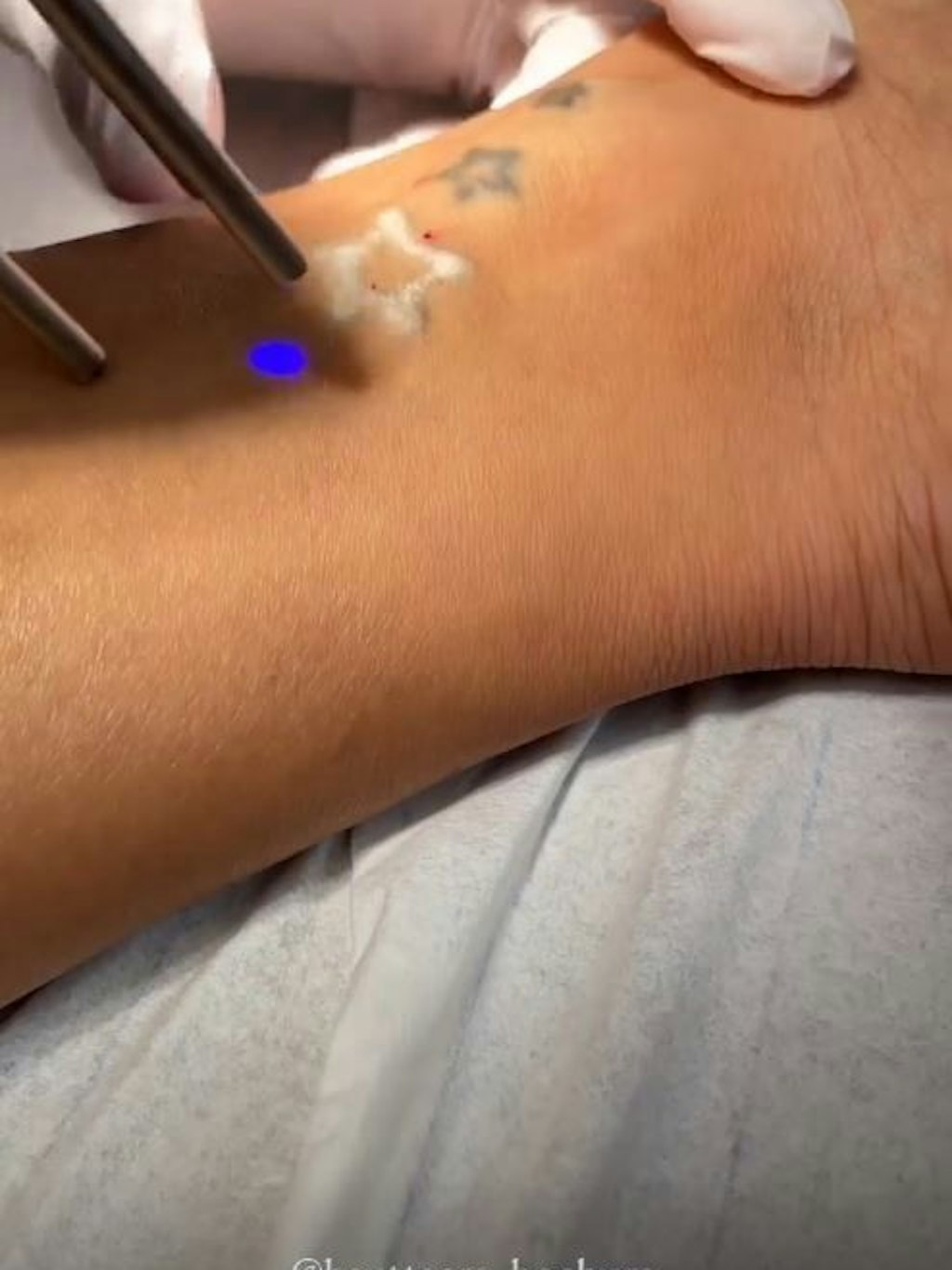 Amira Pocher lässt sich ihre Tattoos entfernen.