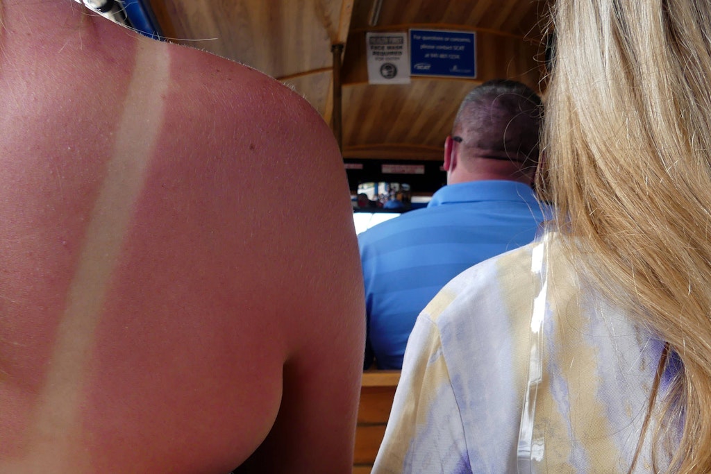 Eine Frau hat einen eindeutigen Sonnenbrand am Rücken.