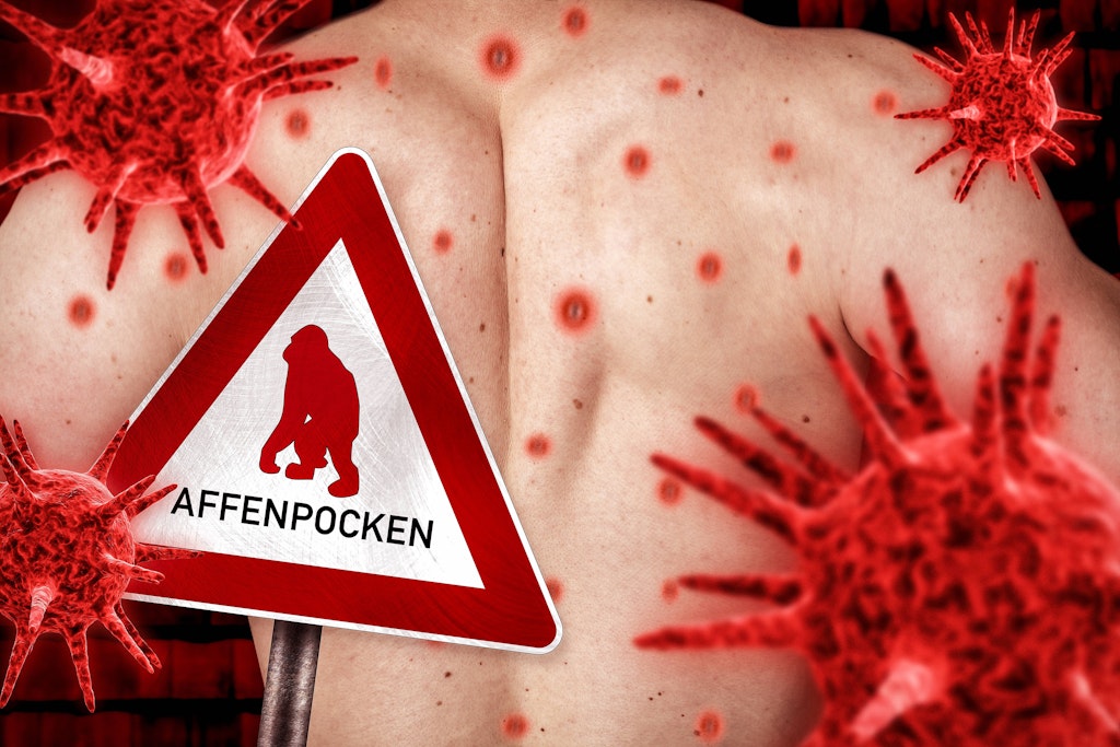 Affenpocken sind auf dem Vormarsch. In Berlin wird ab Mittwoch groß geimpft.