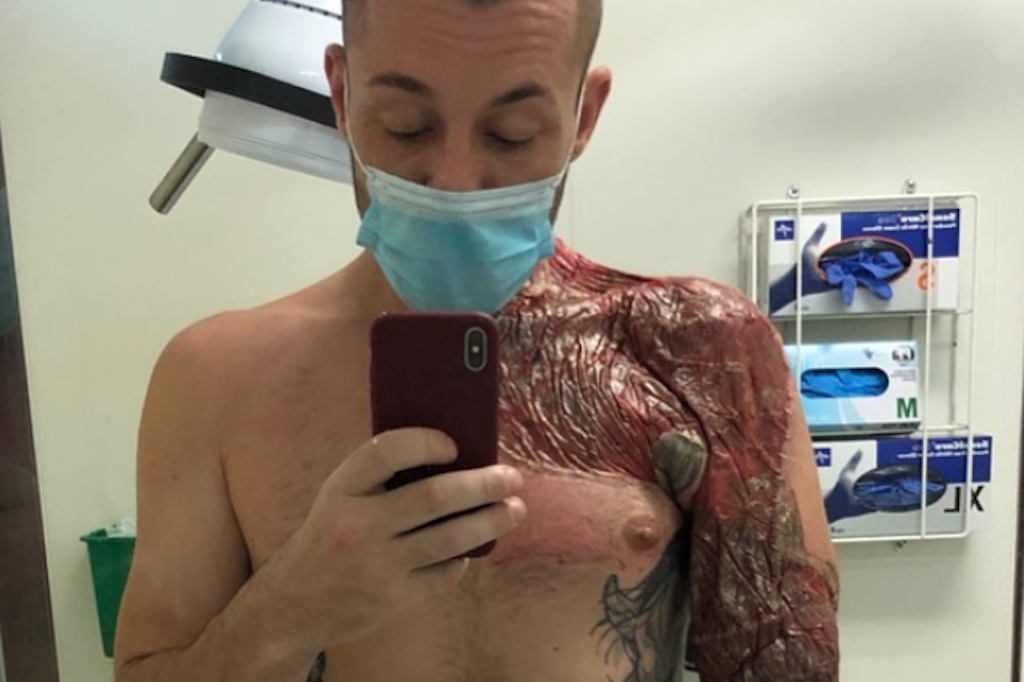 Gabriel Lieschke verlor nach einer Routine-OP seinen rechten Arm – weil die fleischfressende Krankheit das Gewebe zerstörte.