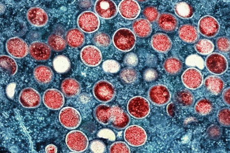 Mpox-Virus: Infektionen in Berlin drastisch gestiegen